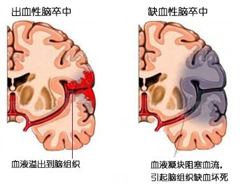 脑中风的先兆和口诀，你记住了吗？