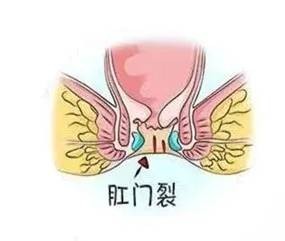 广州东大肛肠医院：“哨兵痔”是肛门口的哨兵，你了解它吗？