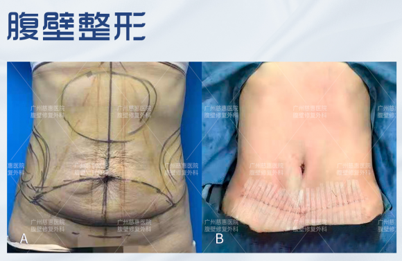 腹部整形手术前后图片图片
